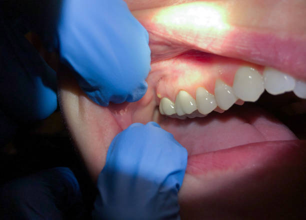 Best Emergency Denture Repair in Spring Mount, PA