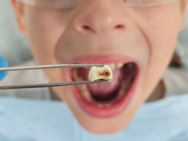 Best Emergency Tooth Extraction in Spring Mount, PA